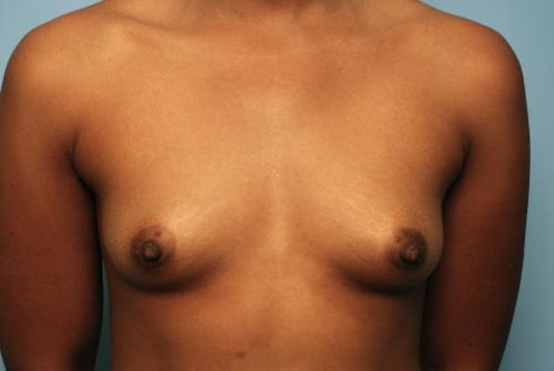Breast Augmentation Before & After Gallery - Patient 127071 - Image 1