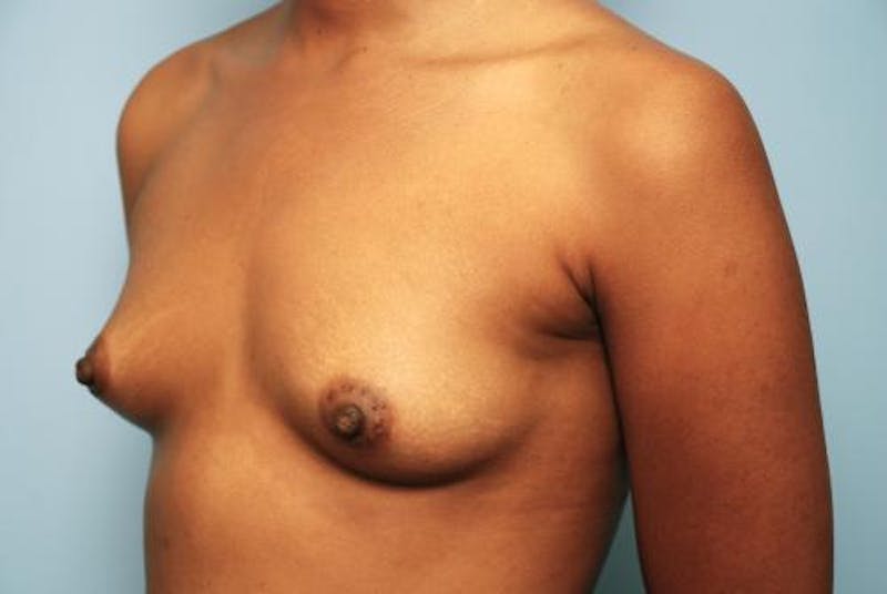 Breast Augmentation Before & After Gallery - Patient 127071 - Image 7