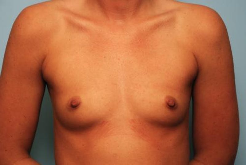 Breast Augmentation Before & After Gallery - Patient 405789 - Image 1