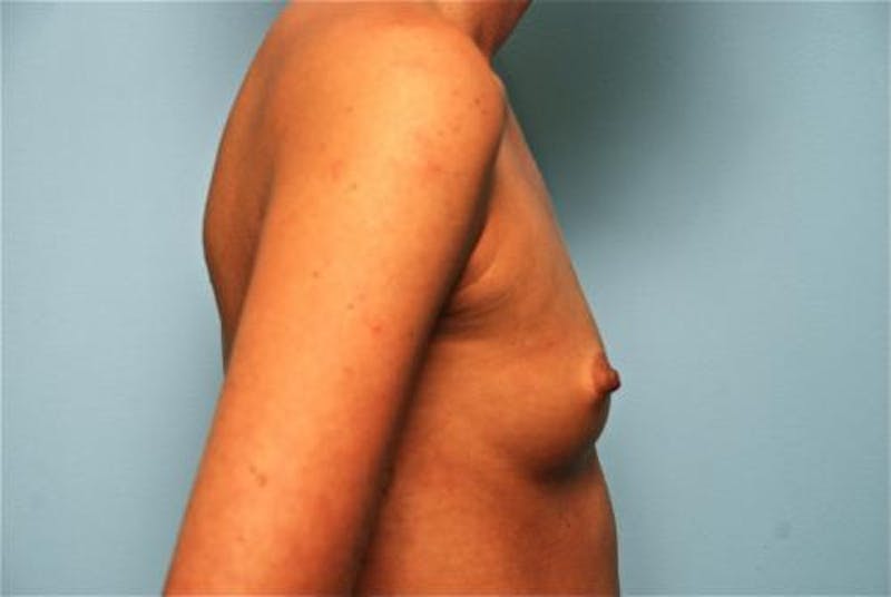Breast Augmentation Before & After Gallery - Patient 405789 - Image 5