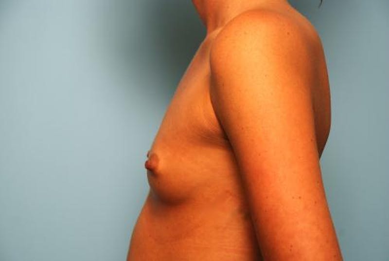 Breast Augmentation Before & After Gallery - Patient 405789 - Image 9