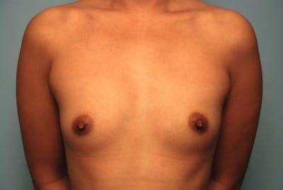 Breast Augmentation Before & After Gallery - Patient 256157 - Image 1