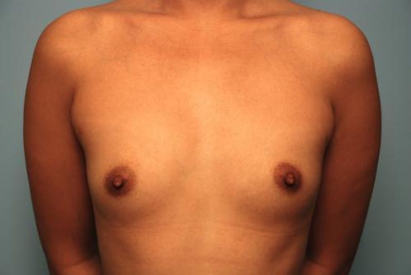 Breast Augmentation Before & After Gallery - Patient 256157 - Image 1