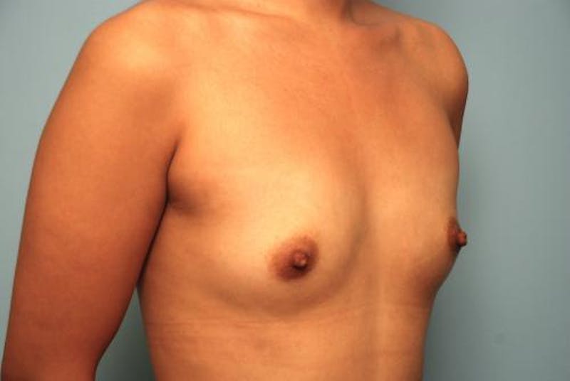 Breast Augmentation Before & After Gallery - Patient 256157 - Image 3
