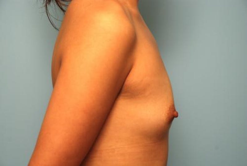 Breast Augmentation Before & After Gallery - Patient 256157 - Image 5