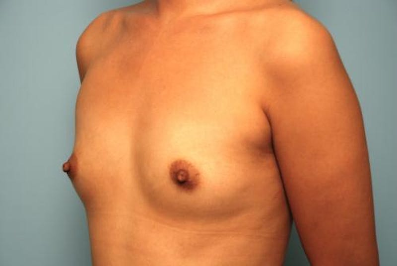 Breast Augmentation Before & After Gallery - Patient 256157 - Image 7