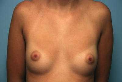 Breast Augmentation Before & After Gallery - Patient 187267 - Image 1