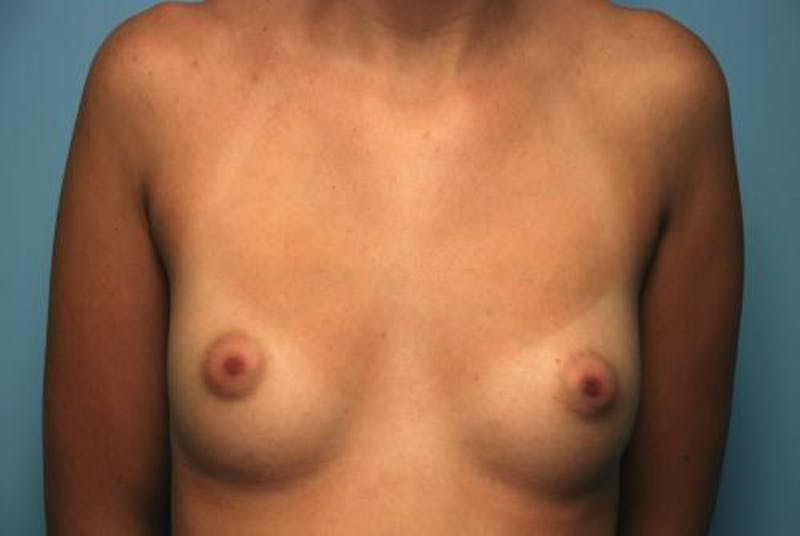 Breast Augmentation Before & After Gallery - Patient 187267 - Image 1