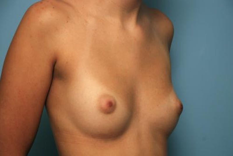 Breast Augmentation Before & After Gallery - Patient 187267 - Image 3