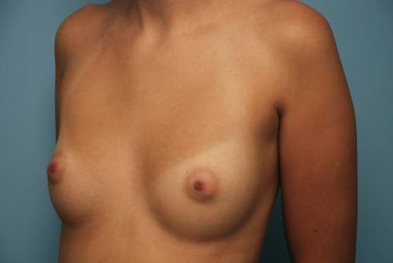 Breast Augmentation Before & After Gallery - Patient 187267 - Image 7