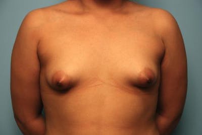 Tubular Breast Deformity Before & After Gallery - Patient 182101 - Image 1