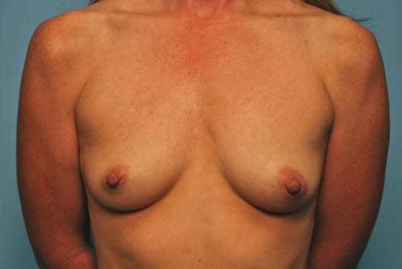 Breast Augmentation Before & After Gallery - Patient 424400 - Image 1