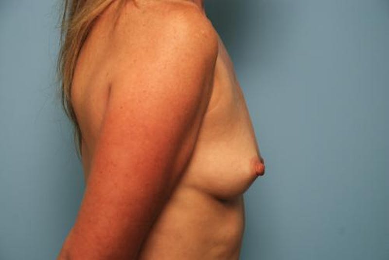 Breast Augmentation Before & After Gallery - Patient 424400 - Image 5