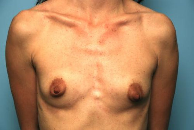 Breast Augmentation Before & After Gallery - Patient 140122 - Image 1