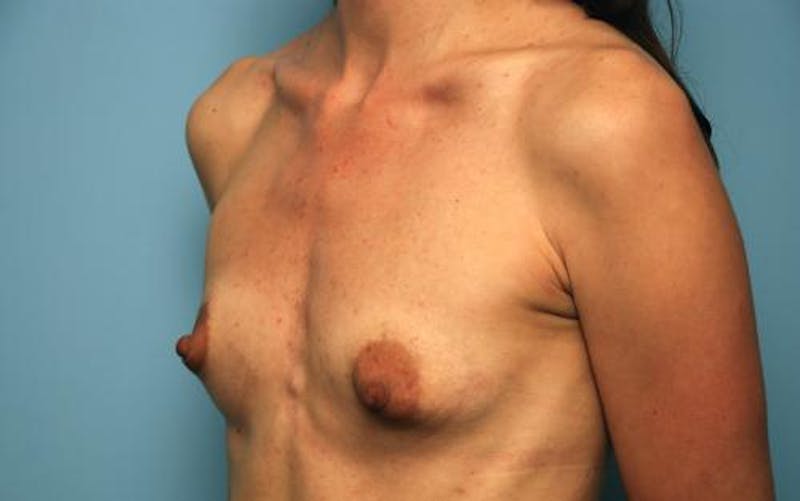 Breast Augmentation Before & After Gallery - Patient 140122 - Image 7