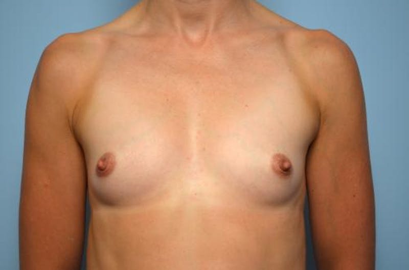 Breast Augmentation Before & After Gallery - Patient 230542 - Image 1