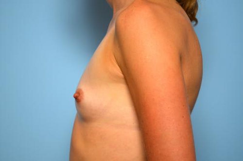 Breast Augmentation Before & After Gallery - Patient 230542 - Image 9