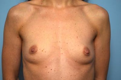 Breast Augmentation Before & After Gallery - Patient 151610 - Image 1