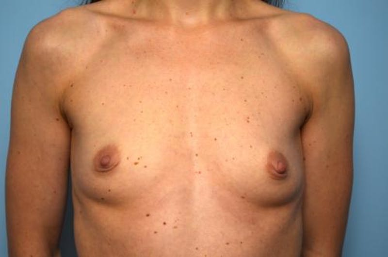 Breast Augmentation Before & After Gallery - Patient 151610 - Image 1
