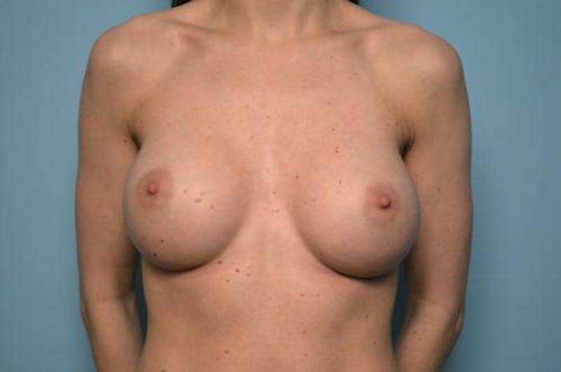 Breast Augmentation Before & After Gallery - Patient 151610 - Image 2