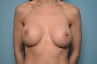 Breast Augmentation Before & After Gallery - Patient 151610 - Image 2