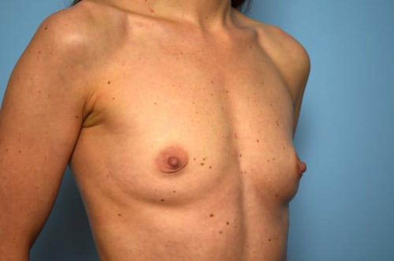 Breast Augmentation Before & After Gallery - Patient 151610 - Image 3