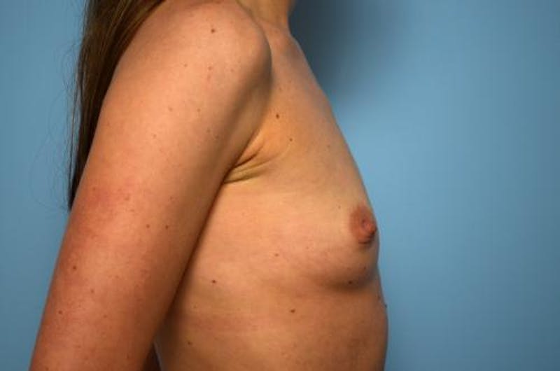 Breast Augmentation Before & After Gallery - Patient 151610 - Image 5