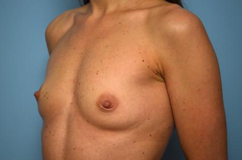 Breast Augmentation Before & After Gallery - Patient 151610 - Image 7