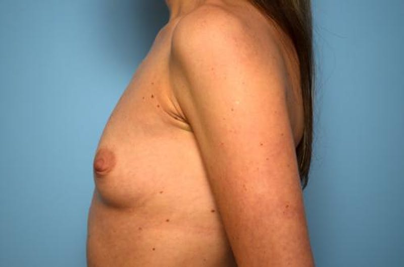 Breast Augmentation Before & After Gallery - Patient 151610 - Image 9
