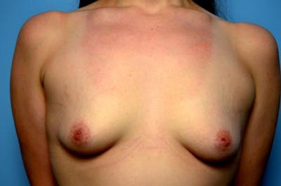 Breast Augmentation Before & After Gallery - Patient 251078 - Image 1