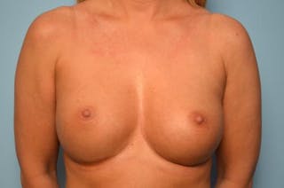 Breast Augmentation Before & After Gallery - Patient 251424 - Image 2