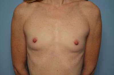 Breast Augmentation Before & After Gallery - Patient 152314 - Image 1