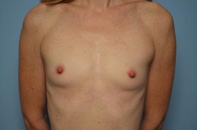 Breast Augmentation Before & After Gallery - Patient 152314 - Image 1