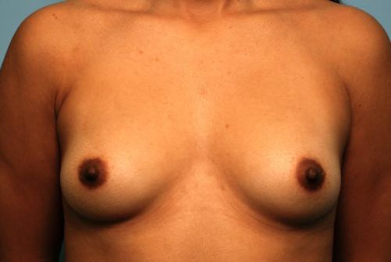 Breast Augmentation Before & After Gallery - Patient 280431 - Image 1