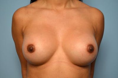 Breast Augmentation Before & After Gallery - Patient 280431 - Image 2