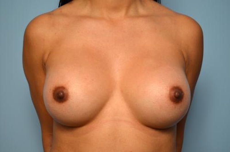 Breast Augmentation Before & After Gallery - Patient 280431 - Image 2