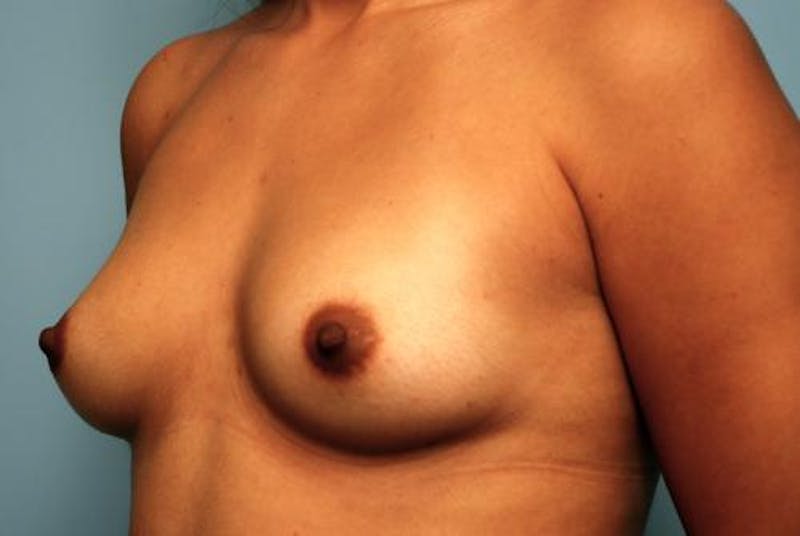 Breast Augmentation Before & After Gallery - Patient 280431 - Image 7