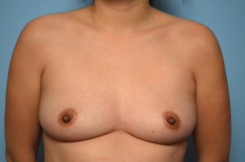 Breast Augmentation Before & After Gallery - Patient 397380 - Image 1