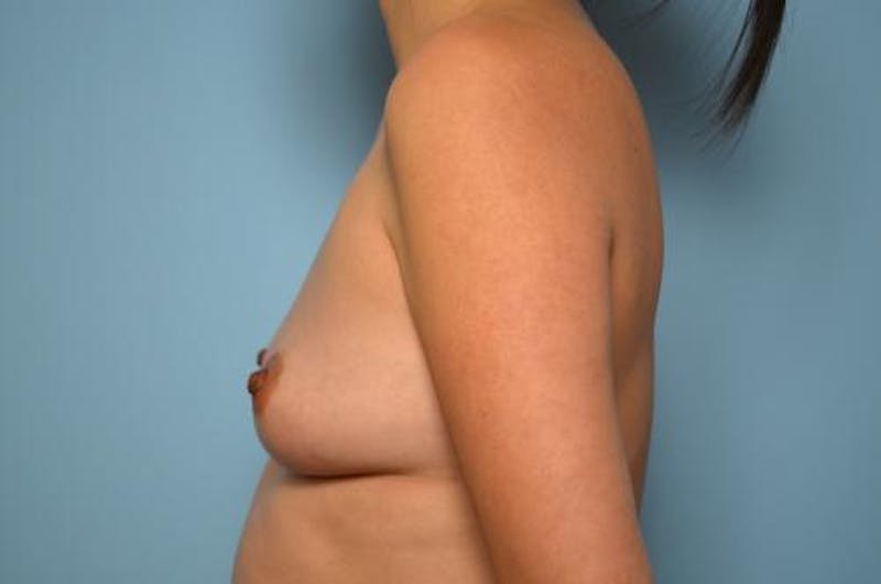 Breast Augmentation Before & After Gallery - Patient 397380 - Image 9