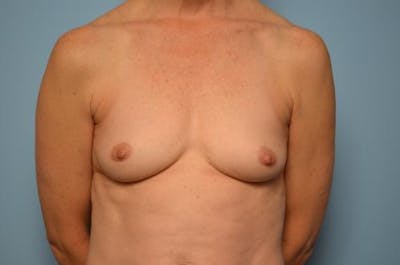 Breast Augmentation Before & After Gallery - Patient 347068 - Image 1