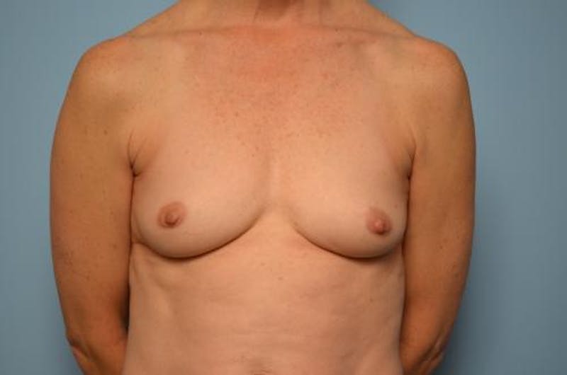 Breast Augmentation Before & After Gallery - Patient 347068 - Image 1