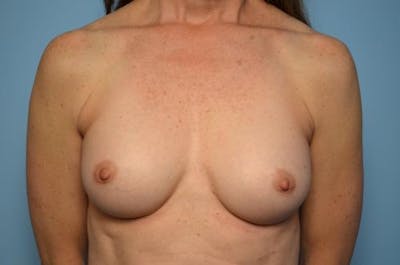 Breast Augmentation Before & After Gallery - Patient 347068 - Image 2