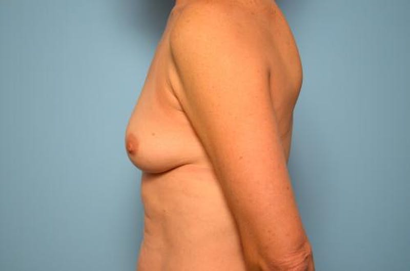 Breast Augmentation Before & After Gallery - Patient 347068 - Image 9