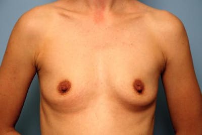 Breast Augmentation Before & After Gallery - Patient 490775 - Image 1
