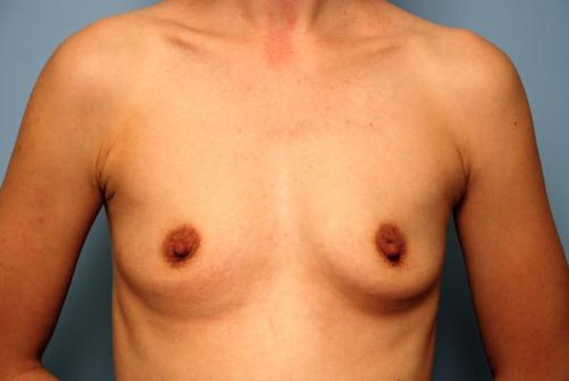 Breast Augmentation Before & After Gallery - Patient 490775 - Image 1