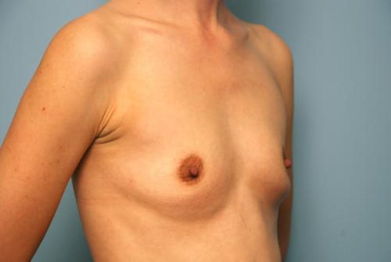 Breast Augmentation Before & After Gallery - Patient 490775 - Image 3