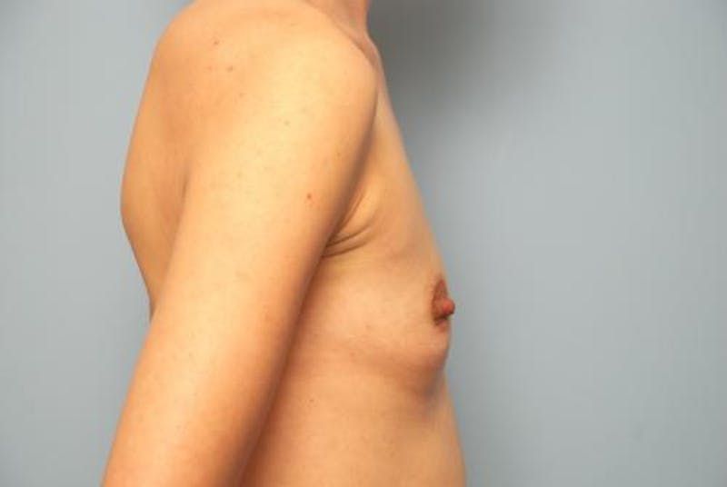 Breast Augmentation Before & After Gallery - Patient 490775 - Image 5
