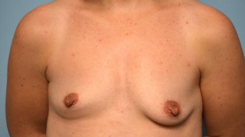 Breast Augmentation Before & After Gallery - Patient 390107 - Image 1