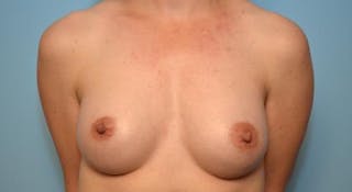 Breast Augmentation Before & After Gallery - Patient 390107 - Image 2