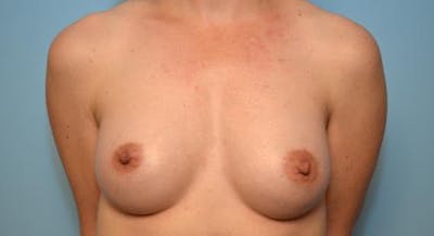 Breast Augmentation Before & After Gallery - Patient 390107 - Image 2